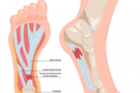 Symptoms of Plantar Fasciitis