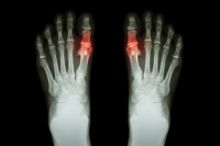 Risk Factors and Symptoms of Gout