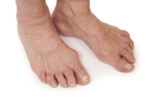 When Rheumatoid Arthritis Disfigures the Feet