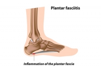 Plantar Fasciitis in Bartenders